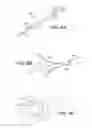 Fig. 14 - Scleral prosthesis for treating presbyopia and other eye disorders and related devices and methods