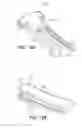 Fig. 17 - Scleral prosthesis for treating presbyopia and other eye disorders and related devices and methods