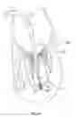 Fig. 14 - Method of securing a leaflet anchor to a mitral valve leaflet