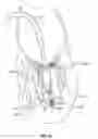 Fig. 15 - Method of securing a leaflet anchor to a mitral valve leaflet