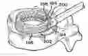 Fig. 01 - Devices For Treating The Spine