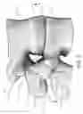 Fig. 04 - Expandable interbody spinal fusion device capable of being deployed endoscopically