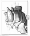 Fig. 06 - Expandable interbody spinal fusion device capable of being deployed endoscopically