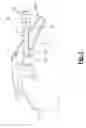 Fig. 06 - Method for surgical application of a glenoid prosthesis component of a shoulder joint prosthesis and relating surgical instruments