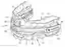 Fig. 01 - Full movement jaw advancement oral appliance to reduce the effects of snoring and/or sleep apnea