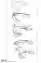 Fig. 06 - Full movement jaw advancement oral appliance to reduce the effects of snoring and/or sleep apnea