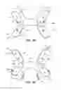 Fig. 03 - Oral appliance device