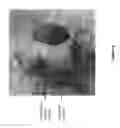 Fig. 07 - SURGICAL DEVICE FOR AB-EXTERNO SUB-RETINAL FLUID DRAINAGE