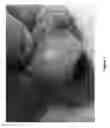 Fig. 08 - SURGICAL DEVICE FOR AB-EXTERNO SUB-RETINAL FLUID DRAINAGE