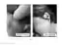 Fig. 06 - Application of methyl 4-[9-(6-aminopuryl)]-2(s)-hydroxybutyrate in preparation of medicament for treating psoriasis and vitiligo