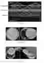 Fig. 02 - Vascularized full thickness tissue-engineered skin assembled by hydrogel, nanofibrous scaffolds and skin cell layers and preparation method thereof