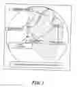 Fig. 02 - Pericardial Space Imaging for Cardiac Support Device Implantation