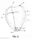 Fig. 04 - Pericardial Space Imaging for Cardiac Support Device Implantation