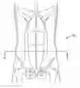 Fig. 01 - Pouch forming catheter
