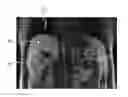 Fig. 01 - METHOD FOR POST-PROCESSING IMAGES FOR COMPENSATING RESPIRATORY MOVEMENTS