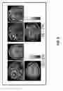 Fig. 09 - Automated, objective method of assessing tinnitus condition