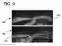 Fig. 12 - Quantitative differentiation of tumor heterogeneity using diffusion MR imaging data