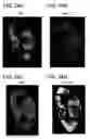 Fig. 25 - Quantitative differentiation of tumor heterogeneity using diffusion MR imaging data