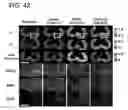 Fig. 43 - Quantitative differentiation of tumor heterogeneity using diffusion MR imaging data