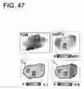 Fig. 46 - Quantitative differentiation of tumor heterogeneity using diffusion MR imaging data