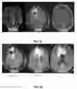 Fig. 55 - Quantitative differentiation of tumor heterogeneity using diffusion MR imaging data