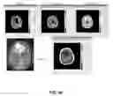 Fig. 56 - Quantitative differentiation of tumor heterogeneity using diffusion MR imaging data