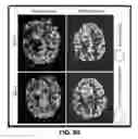 Fig. 57 - Quantitative differentiation of tumor heterogeneity using diffusion MR imaging data