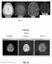 Fig. 58 - Quantitative differentiation of tumor heterogeneity using diffusion MR imaging data