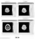 Fig. 59 - Quantitative differentiation of tumor heterogeneity using diffusion MR imaging data