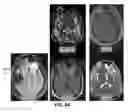 Fig. 60 - Quantitative differentiation of tumor heterogeneity using diffusion MR imaging data