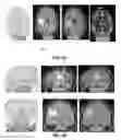 Fig. 63 - Quantitative differentiation of tumor heterogeneity using diffusion MR imaging data