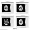 Fig. 64 - Quantitative differentiation of tumor heterogeneity using diffusion MR imaging data