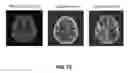 Fig. 66 - Quantitative differentiation of tumor heterogeneity using diffusion MR imaging data