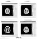 Fig. 67 - Quantitative differentiation of tumor heterogeneity using diffusion MR imaging data