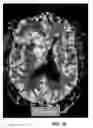 Fig. 68 - Quantitative differentiation of tumor heterogeneity using diffusion MR imaging data