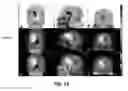 Fig. 69 - Quantitative differentiation of tumor heterogeneity using diffusion MR imaging data