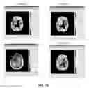 Fig. 70 - Quantitative differentiation of tumor heterogeneity using diffusion MR imaging data