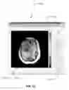 Fig. 71 - Quantitative differentiation of tumor heterogeneity using diffusion MR imaging data
