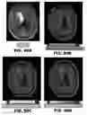 Fig. 74 - Quantitative differentiation of tumor heterogeneity using diffusion MR imaging data