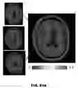 Fig. 75 - Quantitative differentiation of tumor heterogeneity using diffusion MR imaging data