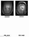 Fig. 77 - Quantitative differentiation of tumor heterogeneity using diffusion MR imaging data
