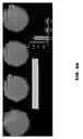 Fig. 79 - Quantitative differentiation of tumor heterogeneity using diffusion MR imaging data
