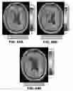 Fig. 80 - Quantitative differentiation of tumor heterogeneity using diffusion MR imaging data