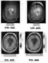 Fig. 83 - Quantitative differentiation of tumor heterogeneity using diffusion MR imaging data