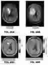 Fig. 84 - Quantitative differentiation of tumor heterogeneity using diffusion MR imaging data