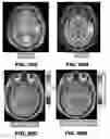 Fig. 85 - Quantitative differentiation of tumor heterogeneity using diffusion MR imaging data