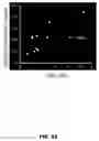 Fig. 86 - Quantitative differentiation of tumor heterogeneity using diffusion MR imaging data