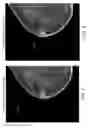 Fig. 07 - Mapping of breast arterial calcifications