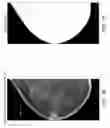Fig. 09 - Mapping of breast arterial calcifications