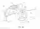 Fig. 09 - Flexible anchor delivery system
